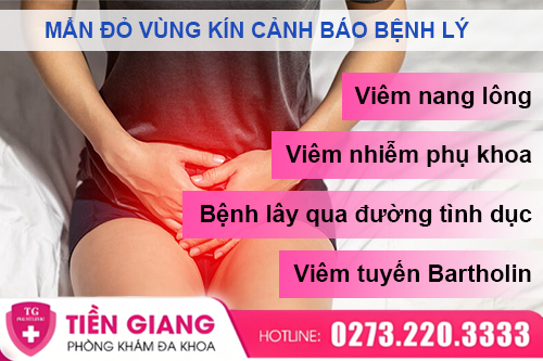 Vùng Kín Bị Nổi Mẩn Đỏ: Dấu Hiệu Nhẹ Hay Bệnh Lý Nguy Hiểm?