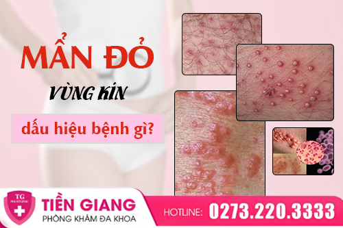 Vùng Kín Bị Nổi Mẩn Đỏ: Dấu Hiệu Nhẹ Hay Bệnh Lý Nguy Hiểm?