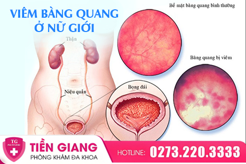 Viêm Bàng Quang Ở Nữ: Khi Nào Cần Điều Trị Sớm