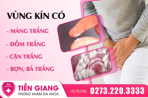 Vùng Kín Có Mảng Bám Màu Trắng – Cảnh Báo Viêm Nhiễm Phụ Khoa