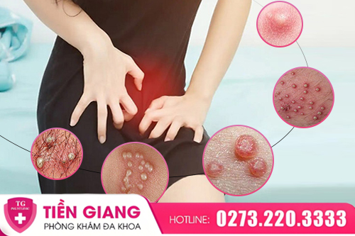 Âm Đạo Nổi Hột: Dấu Hiệu Sinh Lý Hay Cảnh Báo Bệnh Lý?