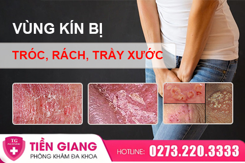 Vùng Kín Bị Tróc, Rách, Trầy Xước: Dấu Hiệu Tổn Thương Hay Bệnh Lý?